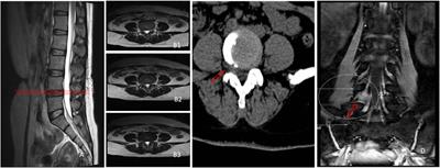 Diagnostic values of 2 different techniques for controversial lumbar disc herniation by conventional imaging examination: 3D-DESS vs. CT plain scan